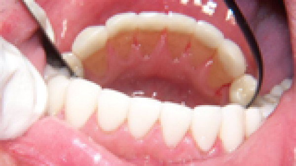 Les facettes dentaires céramiques